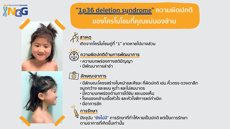 1p36 deletion syndrome ความผิดปกติโครโมโซมที่คุณแม่มองข้าม