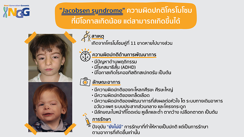 Jacobsen syndrome ความผิดปกติโครโมโซมที่มีโอกาสเกิดน้อย แต่สามารถเกิดขึ้นได้