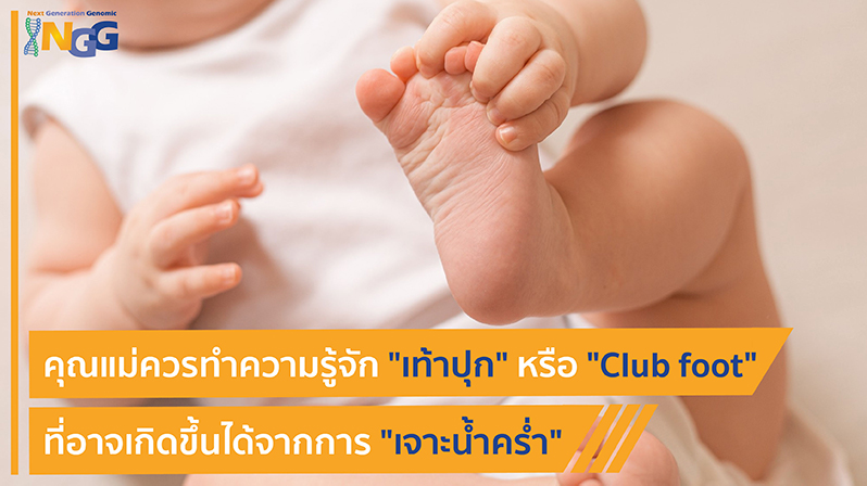 คุณแม่ควรทำความรู้จัก เท้าปุก หรือ Club foot ที่อาจเกิดขึ้นได้จากการเจาะน้ำคร่ำ