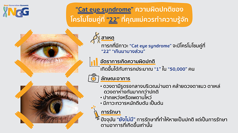 Cat eye syndrome ความผิดปกติของโครโมโซมคู่ที่ 22 ที่คุณแม่ควรทำความรู้จัก