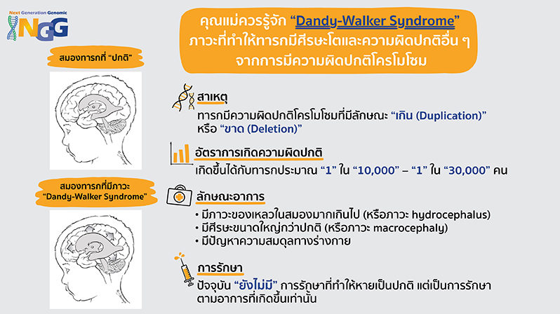 คุณแม่ควรรู้จัก Dandy-Walker Syndrome ภาวะที่ทำให้ทารกมีศีรษะโตและความผิดปกติอื่น ๆ จากการมีความผิดปกติโครโมโซม