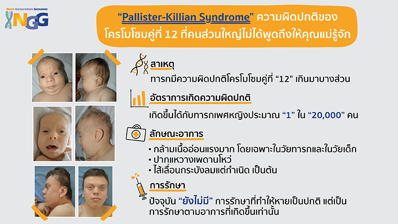 Pallister-Killian Syndrome ความผิดปกติโครโมโซมคู่ที่ 12 ที่คนส่วนใหญ่ไม่ได้พูดถึงให้คุณแม่รู้จัก