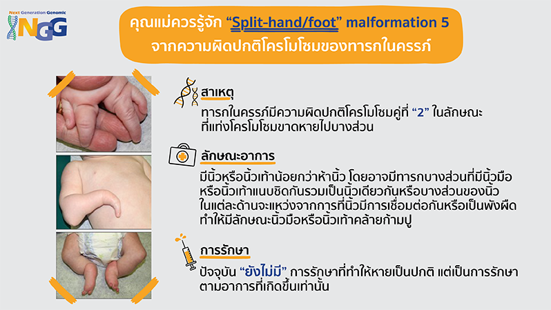 คุณแม่ควรรู้จัก Split-hand/foot malformation 5 จากความผิดปกติโครโมโซมของทารกในครรภ์