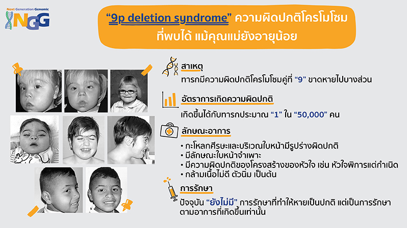 9p deletion syndrome ความผิดปกติโครโมโซมที่พบได้ แม้คุณแม่ยังอายุน้อย