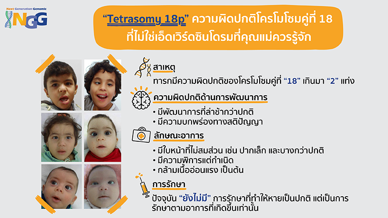 Tetrasomy 18p ความผิดปกติโครโมโซมคู่ที่ 18 ที่ไม่ใช่เอ็ดเวิร์ดซินโดรมที่คุณแม่ควรรู้จัก