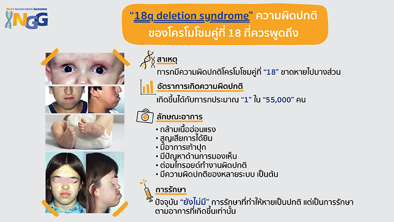 18q deletion syndrome ความผิดปกติโครโมโซมคู่ที่ 18 ที่ควรพูดถึง