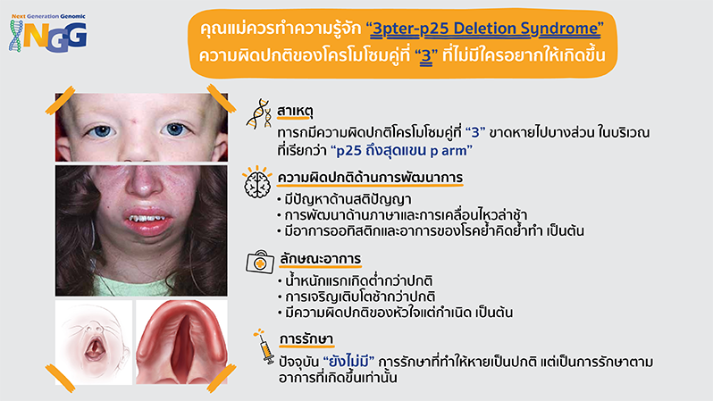 คุณแม่ควรทำความรู้จัก 3pter-p25 Deletion Syndrome ความผิดปกติของโครโมโซมคู่ที่ 3 ที่ไม่มีใครอยากให้เกิดขึ้น